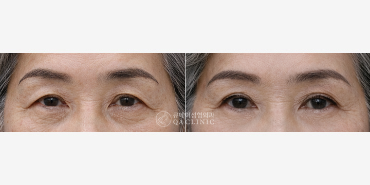 상안검 하안검.png